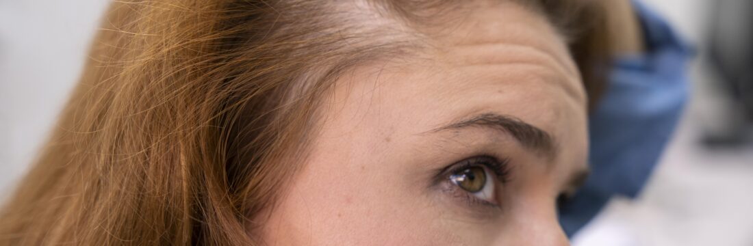 femeie cu parul subtiat din cauza căderii difuze, arata scalpul, close up